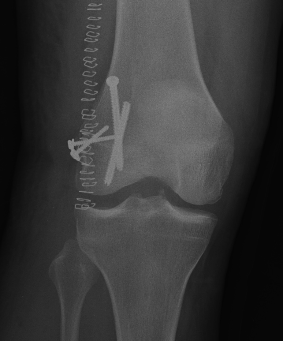 Hoffa Fracture ORIF AP